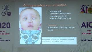 AIOC2020 IC238 T5 Dr Savari Desai Congenital Anophthalmos Microphthalmos Recent Concepts [upl. by Annaihr]