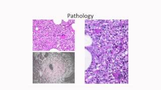 Molecular Profiling of Myelodysplastic Syndromes [upl. by Anialram]