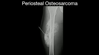 Periosteal Osteosarcoma [upl. by Emelda892]