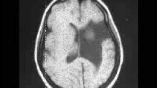 Schizencephaly [upl. by Leonor]