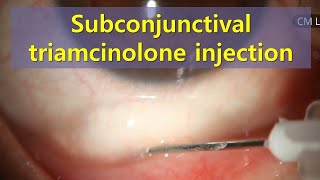 Subconjunctival triamcinolone injection 결막하 트리암시놀론 주사 shorts [upl. by Aihsined348]