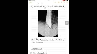 Achalasia cardia surgeryneetpg [upl. by Aserej]