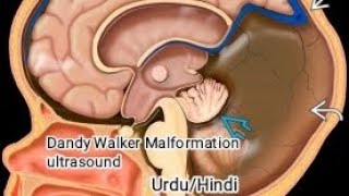 Obstetric ultrasoundDandy Walker Malformation ultrasound [upl. by Havot74]