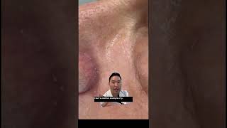 How does a skin cancer appear on the face [upl. by Navap]