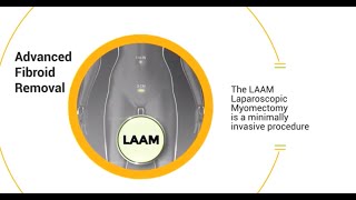 LAAM CIGC’s FastRecovery Laparoscopic Myomectomy [upl. by Skippie]