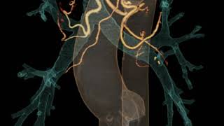 Bronchial artery [upl. by Attiuqihc]