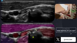 The brachial plexus anatomy sonoanatomy  above the clavicle [upl. by Tema]