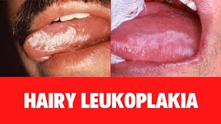 WHAT IS HAIRY LEUKOPLAKIA Oral Hairy Leukoplakia Symptoms Causes Diagnosis Treatment [upl. by Meirrak255]