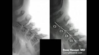 Improvement of cervical anterolisthesis DMX review with Ross Hauser MD [upl. by Cassandre142]