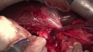 Retroperitoneal liposarcoma with en bloc resection with hepatectomy and vena cava allograft [upl. by Jaine]