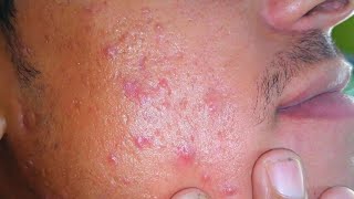 sac be spa blackheads elderly 2024  sac be spa old age blackheads 2024  sac be spa thuy 660 [upl. by Rico]