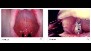 Koplik spots measles rubeola virus [upl. by Punke855]