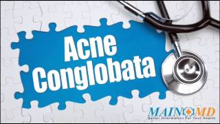 Acne Conglobata ¦ Treatment and Symptoms [upl. by Ylrebmek778]