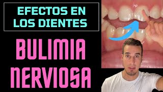 BULIMIA NERVIOSA y ANOREXIA  Así afecta a los DIENTES shorts [upl. by Weir]