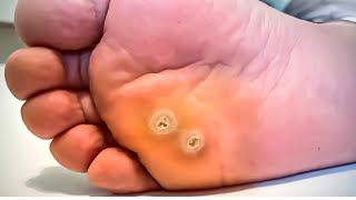 How To Remove a Foot Corn or Callus Foot Doctor Home Treatment [upl. by Esylle146]