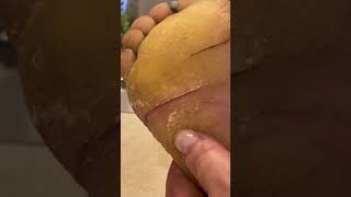 Fissure crack maintenance  Keratoderma Callus EPPK Hyperkeratosis  May 8 2023 [upl. by Lisette368]