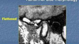 Radiology  Imaging of TemproMandibular Joint [upl. by Aehtla8]