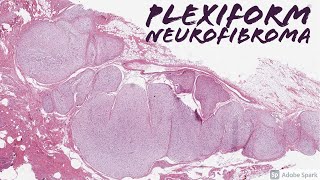 Plexiform Neurofibroma in Neurofibromatosis1 NF1 5Minute Pathology Pearls [upl. by Dragoon]