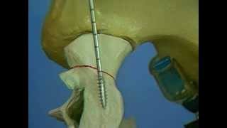 posterior screw fixation of the sacroiliac joint [upl. by Nhojleahcim]