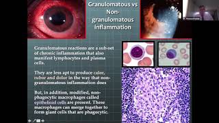 Lecture Granulomatous Disease in an Eye Practice [upl. by Hodgson]