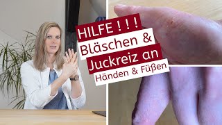 4K Juckende Bläschen an den Händen oder Füßen  Handekzem  Diagnose  Tipps  Therapie [upl. by Nicolea]