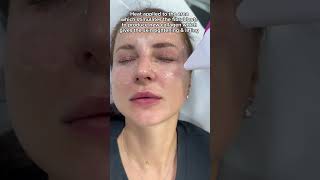 Eye tightening amp lifting with Endy iFine  Dr MediSpa [upl. by Ocire]