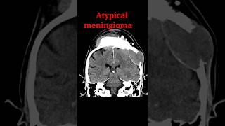 Meningioma shorts radiology education radiologyjunction [upl. by Kreiner]