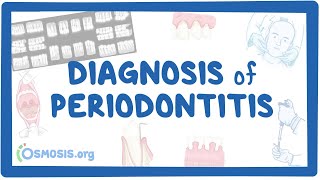 Diagnosis of Periodontitis [upl. by Ennayram117]