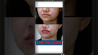 Get READY for Plump Lips with Lip Fillers  Sarayu Clinics filler [upl. by Hutt]