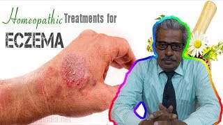 Eczema Dermatitis Treatment in Homeopathy by Dr PS Tiwari [upl. by Skinner808]