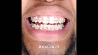 Braces 6 Month Timelapse [upl. by Leigha]