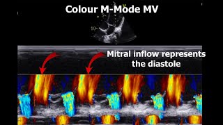 Rheumatic Vs NonRheumatic Mitral Regurgitation Echocardiography [upl. by Marte91]