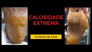 Impressionante Calosidade Extrema nos Pés  15 ANOS COM DOR PARTE 1 [upl. by Feriga]