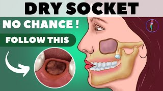 Tooth extraction aftercare I Wisdom tooth extraction  Tips for faster healing amp prevent dry socket [upl. by Seaman]