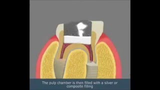 بتر اللب pulpotomy جامعة دمشق كلية طب الاسنان [upl. by Myra]