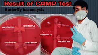 CAMP Test result  Butterfly haemolysis  CAMP Test factor  ve amp ve CAMP Test  Enhanced Haemolys [upl. by Leahplar]