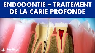 Endodontie  Traitement de la carie profonde © [upl. by Jolyn]