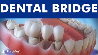 Dental bridge  Fixed dental replacement © [upl. by Doowrehs]