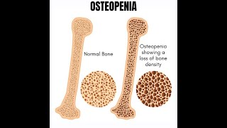 Osteopenia [upl. by Yobybab]