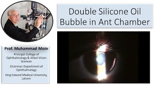 Double Silicone oil bubble in AC after complicated vitrectomy [upl. by Cerracchio883]