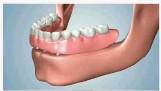 overdenture [upl. by Halverson]