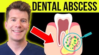 Doctor explains DENTAL ABSCESS tooth abscess  Causes symptoms amp treatment [upl. by Ennayrb]