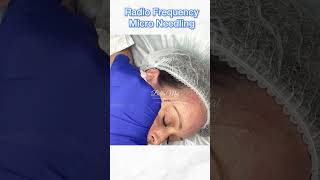 Radio Frequency Micro Needling Face [upl. by Bryana219]