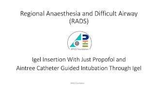 Supraglottic Airway Igel Insertion amp Aintree Guided Intubation [upl. by Fortunia806]