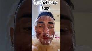 7 Meses depois do procedimento de Fenol Profundo para tratar cicatrizes de acne [upl. by Ahsauqram324]