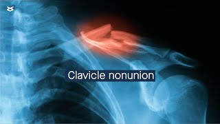 Clavicle nonunion management and considerations [upl. by Nerti]