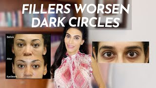 Do Fillers Make Dark Circles WORSE  Under Eye Filler [upl. by Releehw]