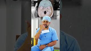 CSF RHINORRHEA in HEAD INJURED patients How to Treat it Dr Prabhu M in Tamil Short 1 [upl. by Lazor243]