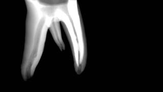 Threerooted mandibular molar Endodontia FOBUSP [upl. by Moulton452]