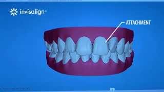 What You Can Expect During Invisalign Treatment [upl. by Blackington]